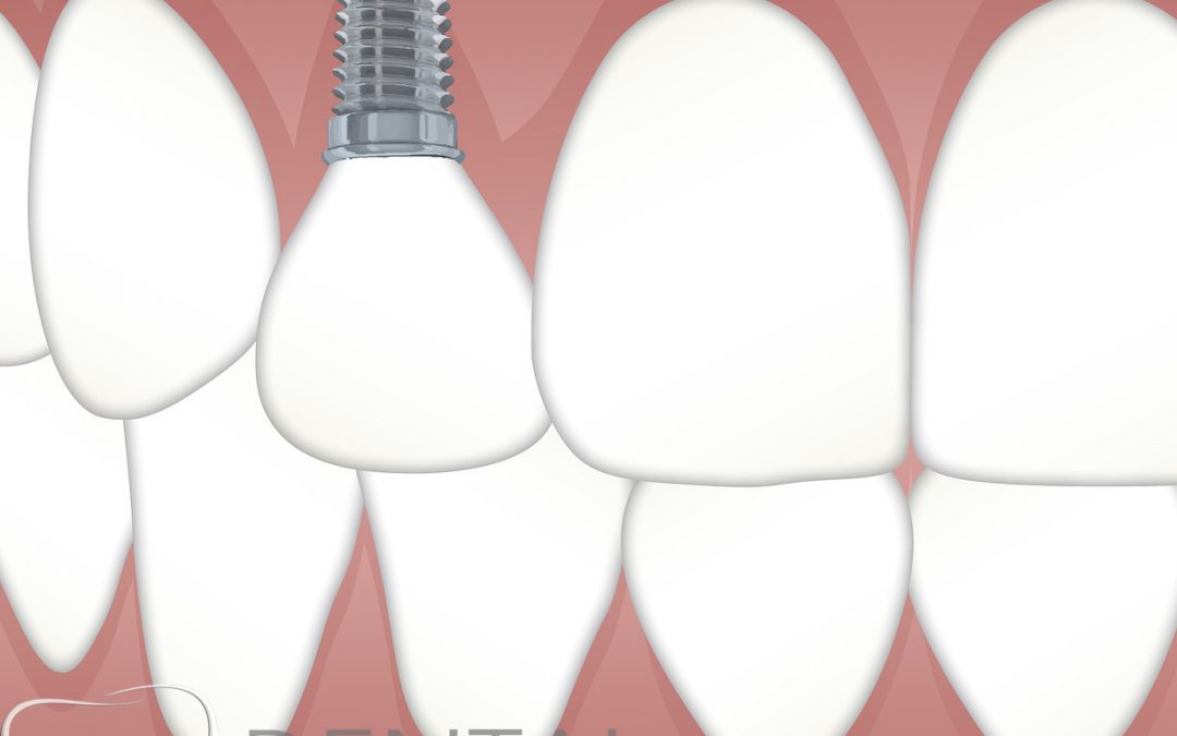¿Que son los implantes dentales?