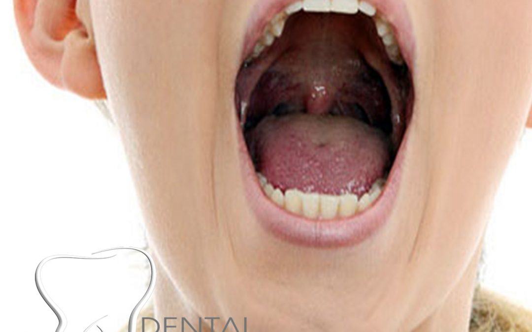 El diagnóstico precoz del cáncer oral salva vidas